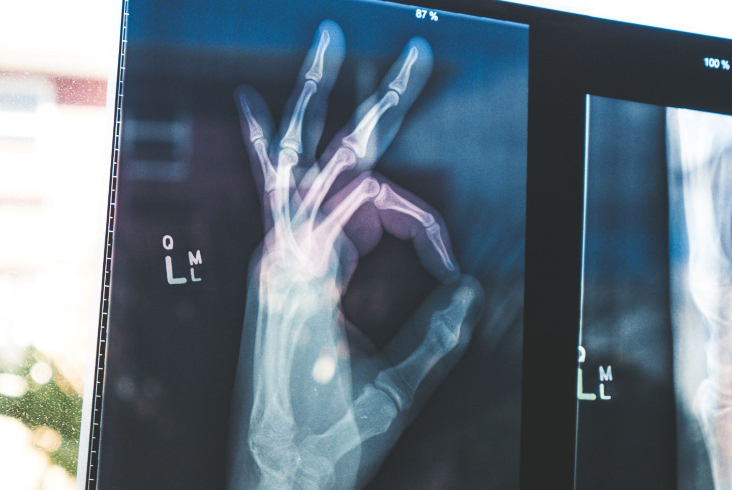 x-ray of broken bone in hand